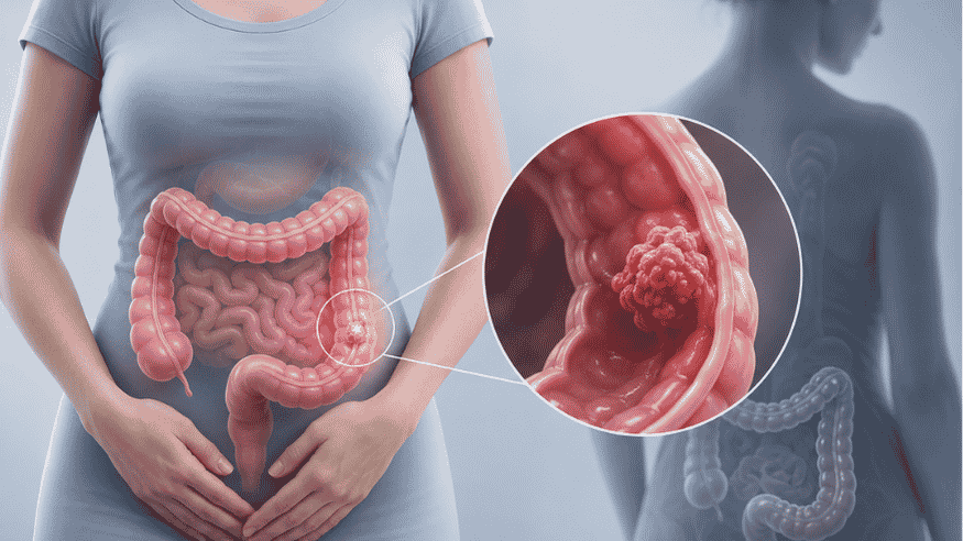 Colon Cancer in Females